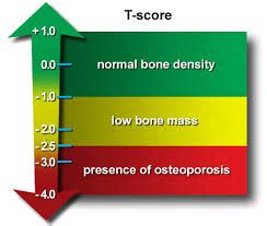 1.3 Understanding Osteoporosis and Bone-Safe Programming at Mbodies Training Academy