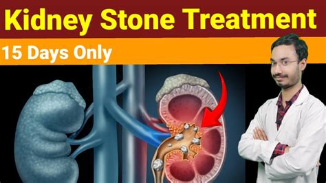 Kidney Stone Treatment | Kidney Stone Diet | Kidney Stone Symptoms | Kidney Stone Pain | Pathri ...