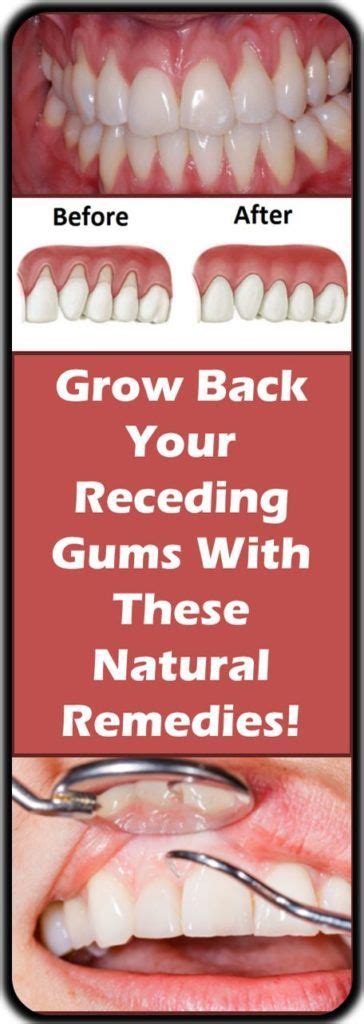 GROW BACK YOUR RECEDING GUMS WITH THESE NATURAL REMEDIES! - | Receding ...