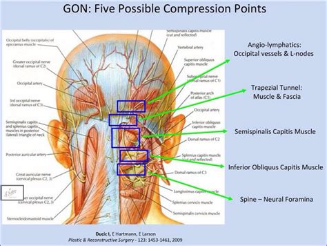 86 best Occipital Neuralgia images on Pinterest