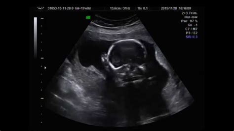 17 weeks pregnant baby moving (tough baby kick) ultrasound - YouTube