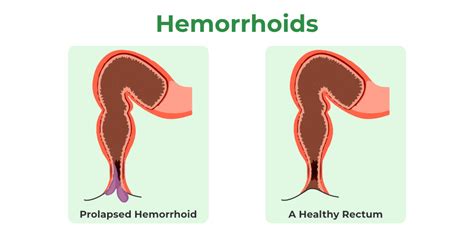 What Is Infected Hemorrhoids Treatment For Hemorrhoids, 49% OFF