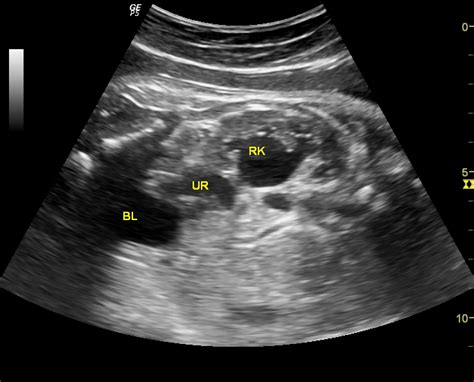 Fetal Hydronephrosis Grading