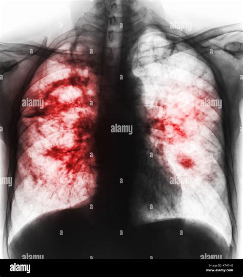 Chest X Ray Of Tb Patient