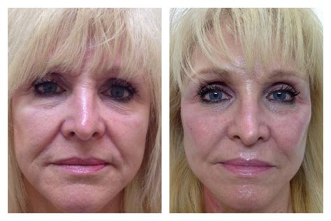 Liquid Facelift | Liquid facelift, Neck lift, Facelift before and after