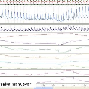 Valsalva ratio is defined as the maximum heart rate during the maneuver ...