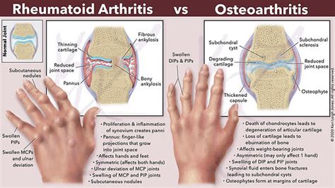 Rheumatoid Arthritis vs Osteoarthritis | Keri Leigh Biomedical Creations