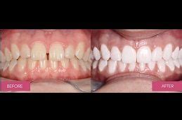 Protruded Teeth Treatment in Dubai & Abu Dhabi | Protruded Teeth Cost