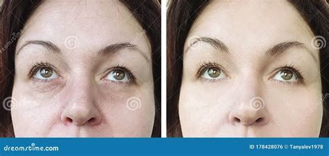 Woman Face Wrinkle before and after Treatment Cosmetology Stock Photo ...