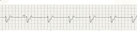 Pulseless Electrical Activity Ecg Strip VERIFIED