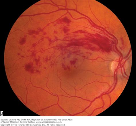 Hypertensive Retinopathy Images