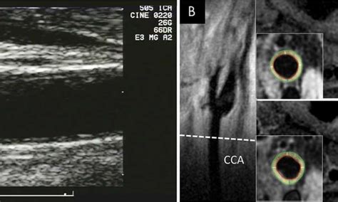 Carotid artery MRI improves risk assessment for cardiovascular disease