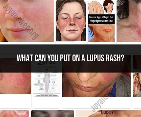 Treating a Lupus Rash: Topical Remedies and Management Strategies ...