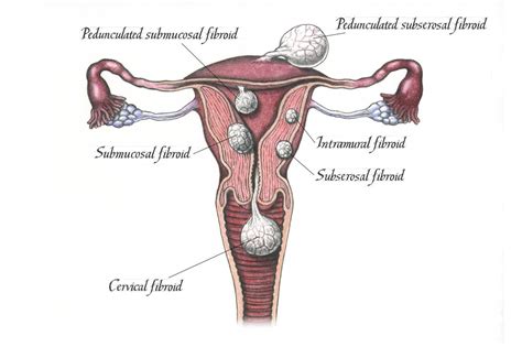 New Treatment for Fibroids Without Surgery - WSJ