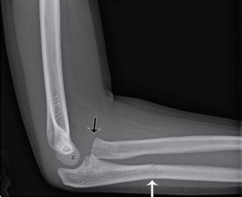 Monteggia Fracture Radiology