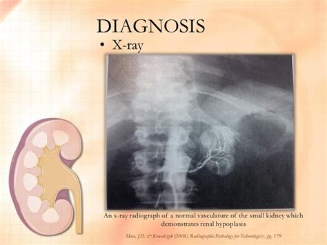 Renal Hypoplasia FINAL OUTPUT by Nica Valencia