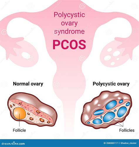 Polycystic Ovary Syndrome PCOS, Hormonal Diagnose, Medical Illustration Stock Vector ...