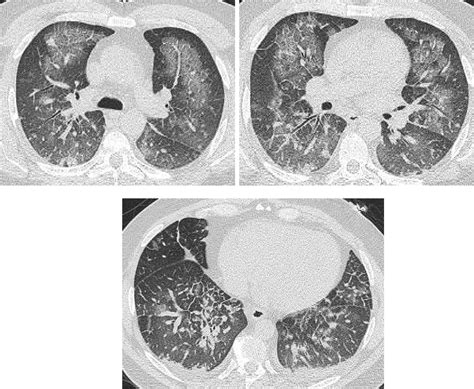 Pulmonary Edema: A Pictorial Review of Imaging Manifestations and Current Understanding of ...