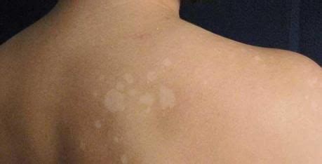 How Can I Remove White Sun Spots? - Paperblog | White skin spots, Sun spots on skin, Sunspots