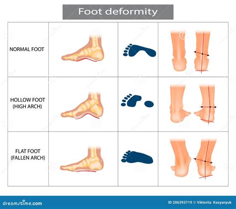 Hollow, Flat, And Normal Foot. Foot Deformity Types, Medical Disease Infographics. Cartoon ...