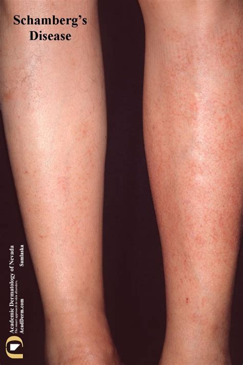 Schamberg's Disease: A Pigmentary Purpuric Eruption... - Academic Dermatology of Nevada