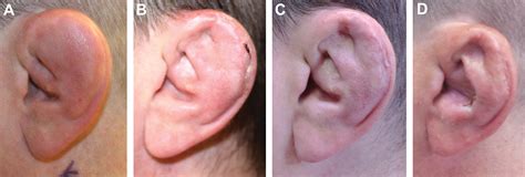 Cauliflower Ear Before And After