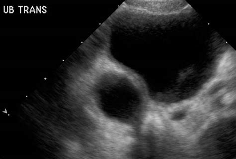 Ureterocele - wikidoc