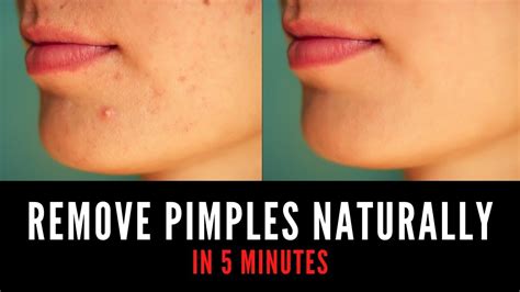 Bump Under Skin But Not Pimple at Abigail Piche blog