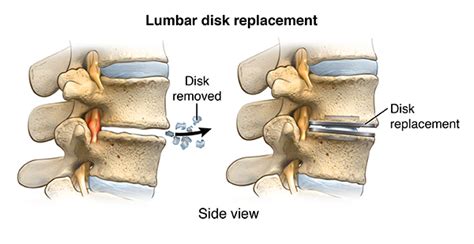 Lumbar Disk Replacement - - Health Information - University of Utah Health Care - Salt Lake City ...