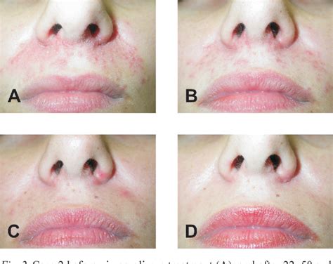 Figure 2 from Pimecrolimus cream 1% is effective in seborrhoeic ...