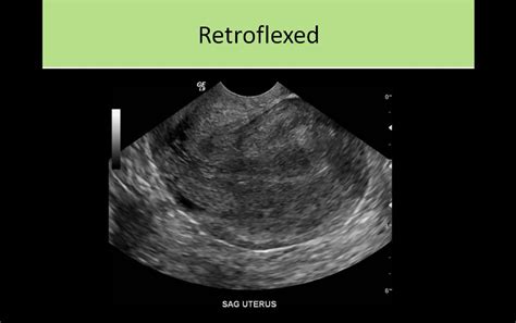 Pelvic Sonography