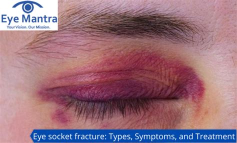 Eye Socket Fracture: Types, Symptoms, Treatment