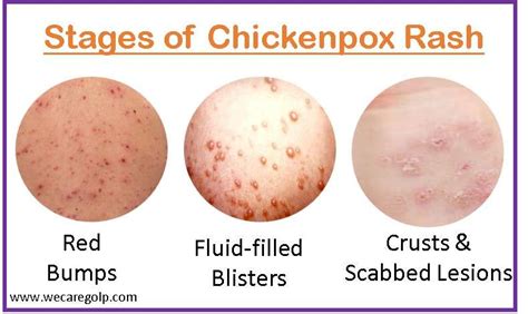 Chickenpox (Varicella-Zoster) - We Care