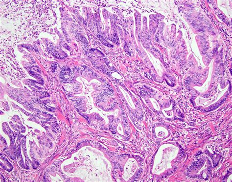 Adenocarcinoma Colon Histology