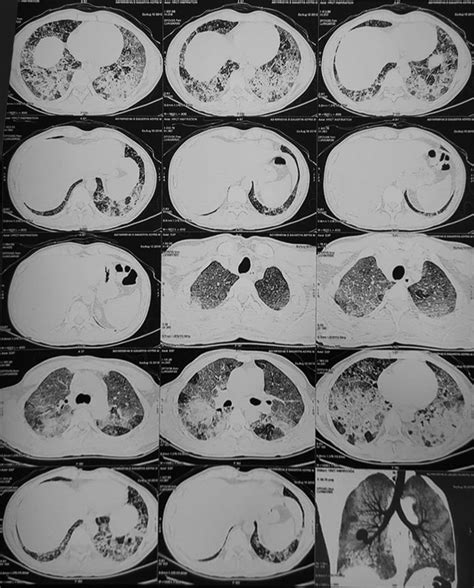 High resolution computed tomography scan showed crazy paving pattern | Download Scientific Diagram