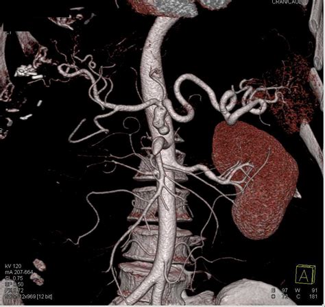 Aneurysm of the Celiac Artery - Vascular Case Studies - CTisus CT Scanning