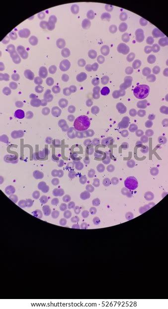 Blood Smear Beta Thalassemia Stock Photo (Edit Now) 526792528