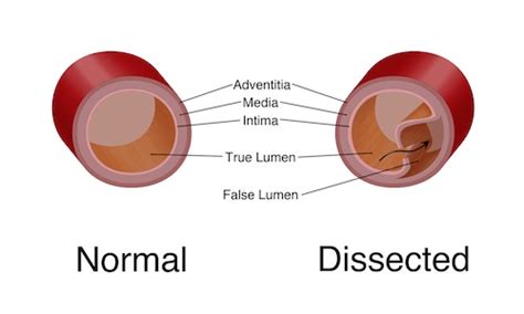 Aortic Dissection | UF Health Aortic Disease Center|Diseases & Treatment | UF Health, University ...