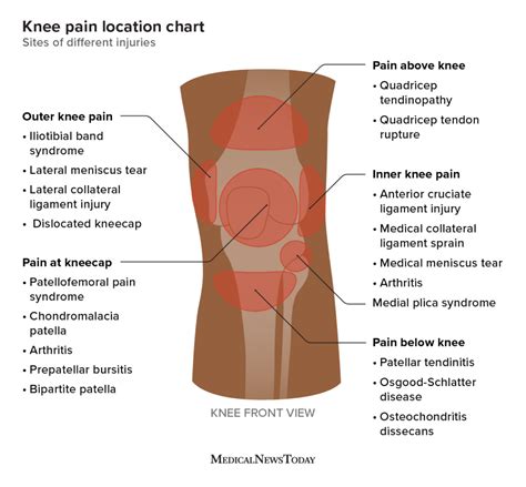 Knee pain location chart: Sites of different injuries