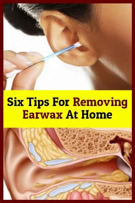 Six Tips Home to Remove Earwax | Remove earwax, Removing earwax at home, Ear wax