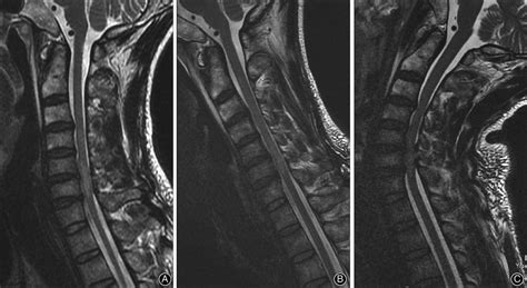 Cervical kinematic MRI of spinal cord injury in a 44-year-old male... | Download Scientific Diagram