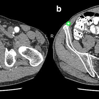 The location of pubic tubercle (a) and anterior superior iliac spine... | Download Scientific ...