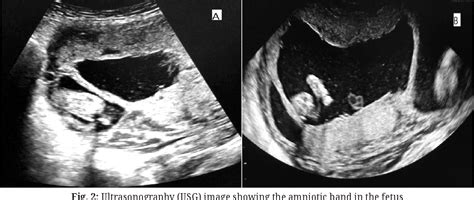 Table 1 from Amniotic Band Syndrome: A Silent Knife In-Utero | Semantic Scholar