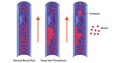 Deep Venous Thrombosis DVT | Venous Thrombosis Treatment