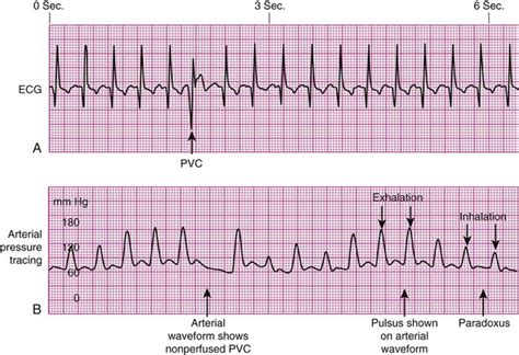 Cardiovascular Diagnostic Procedures | Nurse Key