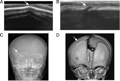 [PDF] Cranial Ultrasound as a First-Line Imaging Examination for Craniosynostosis | Semantic Scholar