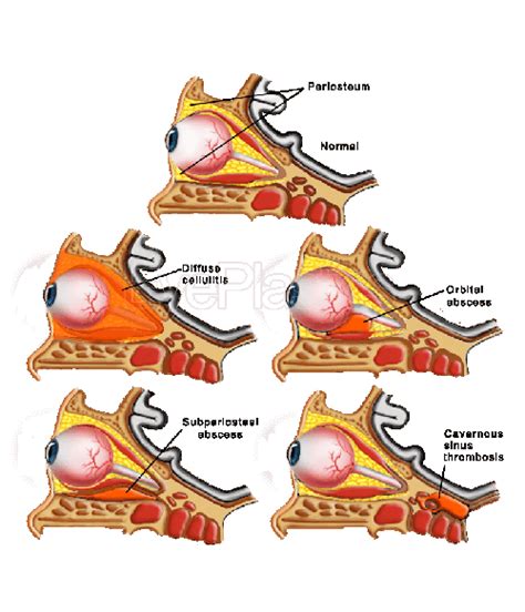 Orbital Abscess Boise | Subperiosteal Abscess Idaho