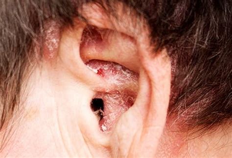Apple Cider Vinegar For Itchy Ears- Home Natural Cures