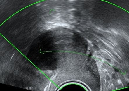 Unicornuate uterus (3D ultrasound) | Radiology Case | Radiopaedia.org