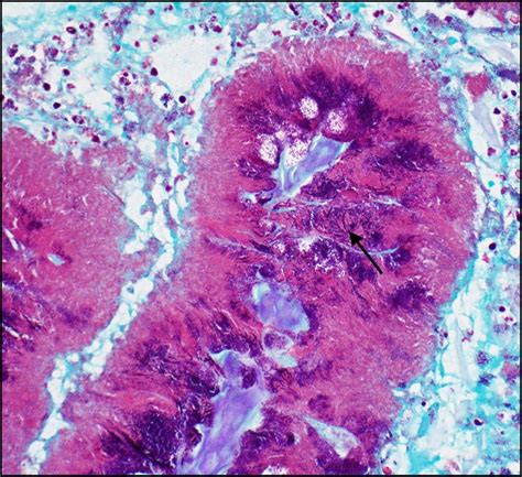 Gram stain showing gram-positive, filamentous, rods of actinomyces ...